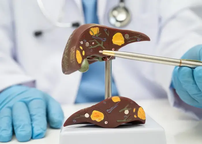 Fatty liver care nutrition and lifestyle support